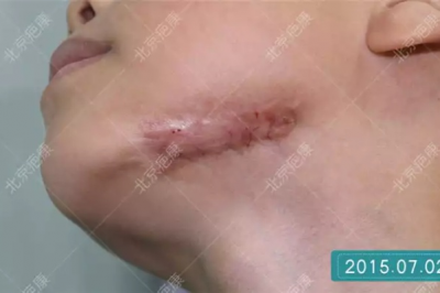 各位怎么祛疤痕最快，除了整形医院手术还有什么好方法 
