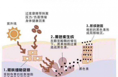 祛斑最好的方法 目前最有效的