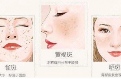 祛斑真的管用吗 