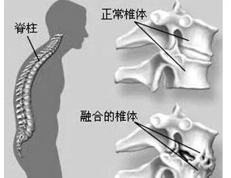强直性颈椎病怎么治 