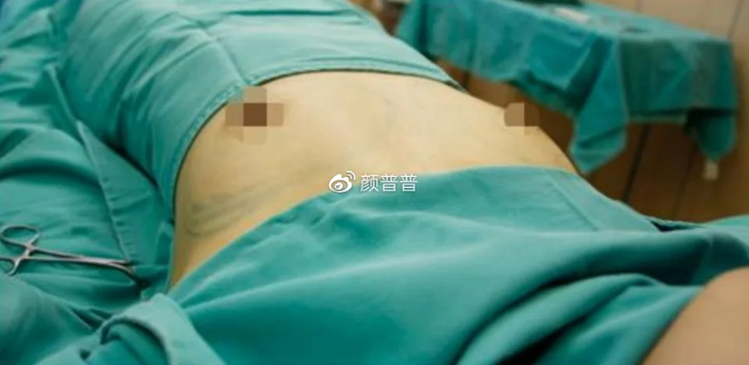 抽脂肪丰胸好吗 