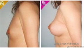 女生怎么丰胸最有效果 