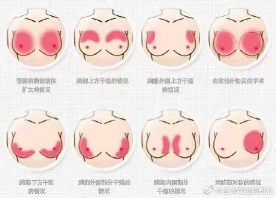丰胸自体脂肪能管多久 